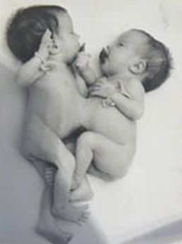 Букет в лицо. Как в СССР впервые успешно разделили сиамских близняшек
Букет в лицо. Как в СССР впервые успешно разделили сиамских близняшек